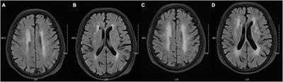 Comparing the Performance of Two Radiomic Models to Predict Progression and Progression Speed of White Matter Hyperintensities